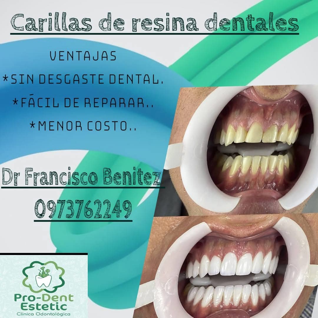 CARILLAS DENTAL DE RESINA